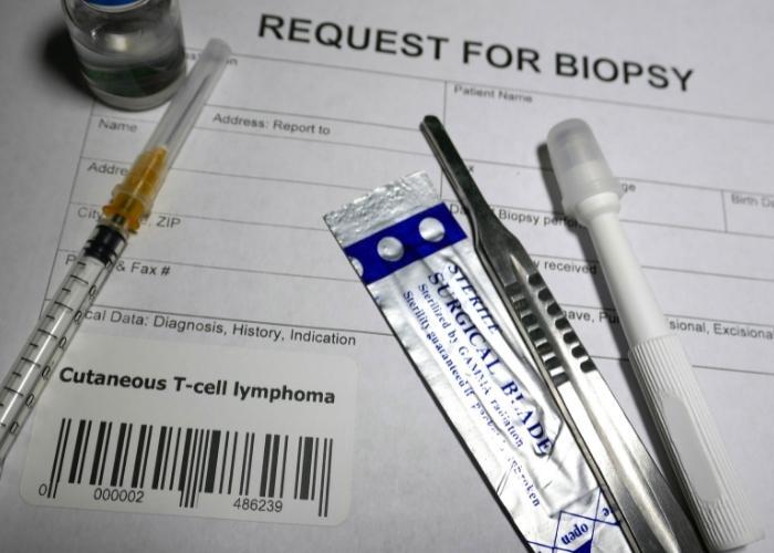 biopsia y lenalidomida