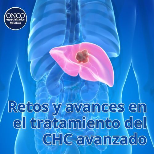 Hígado afectado por carcinoma hepatocelular avanzado y avances en su tratamiento.