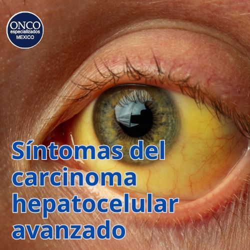 Ojo con ictericia, síntoma clave del carcinoma hepatocelular avanzado.