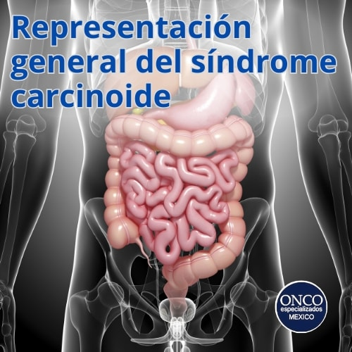 Sistema digestivo afectado por síndrome carcinoide