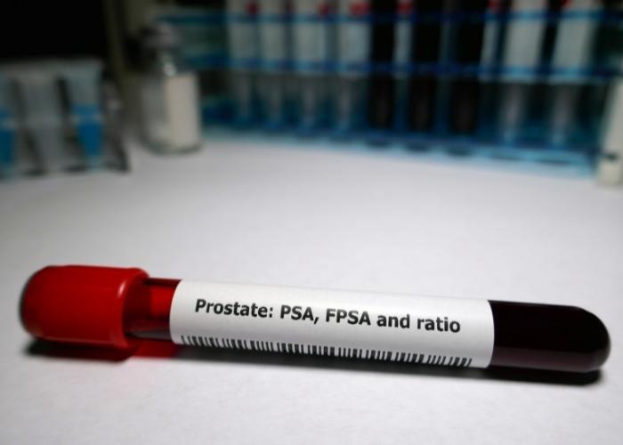 Tubo de muestra de sangre etiquetado como “Próstata: PSA, FPSA y relación” sobre una superficie blanca, tapa roja visible
