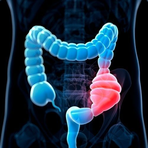 Ilustración médica en 3D de un colon, con el colon sigmoide resaltado en rosa y otras secciones en azul.