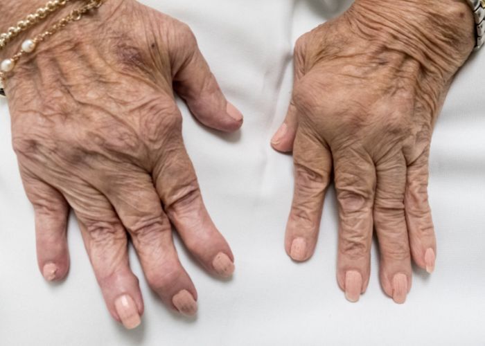 AR artritis reumatoide 2023