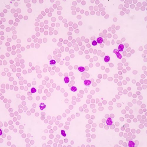 leucemia mieloide