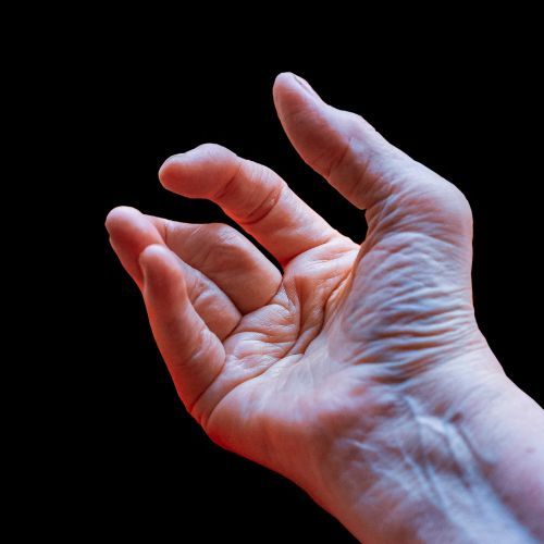 Artritis reumatoide trastuzumab