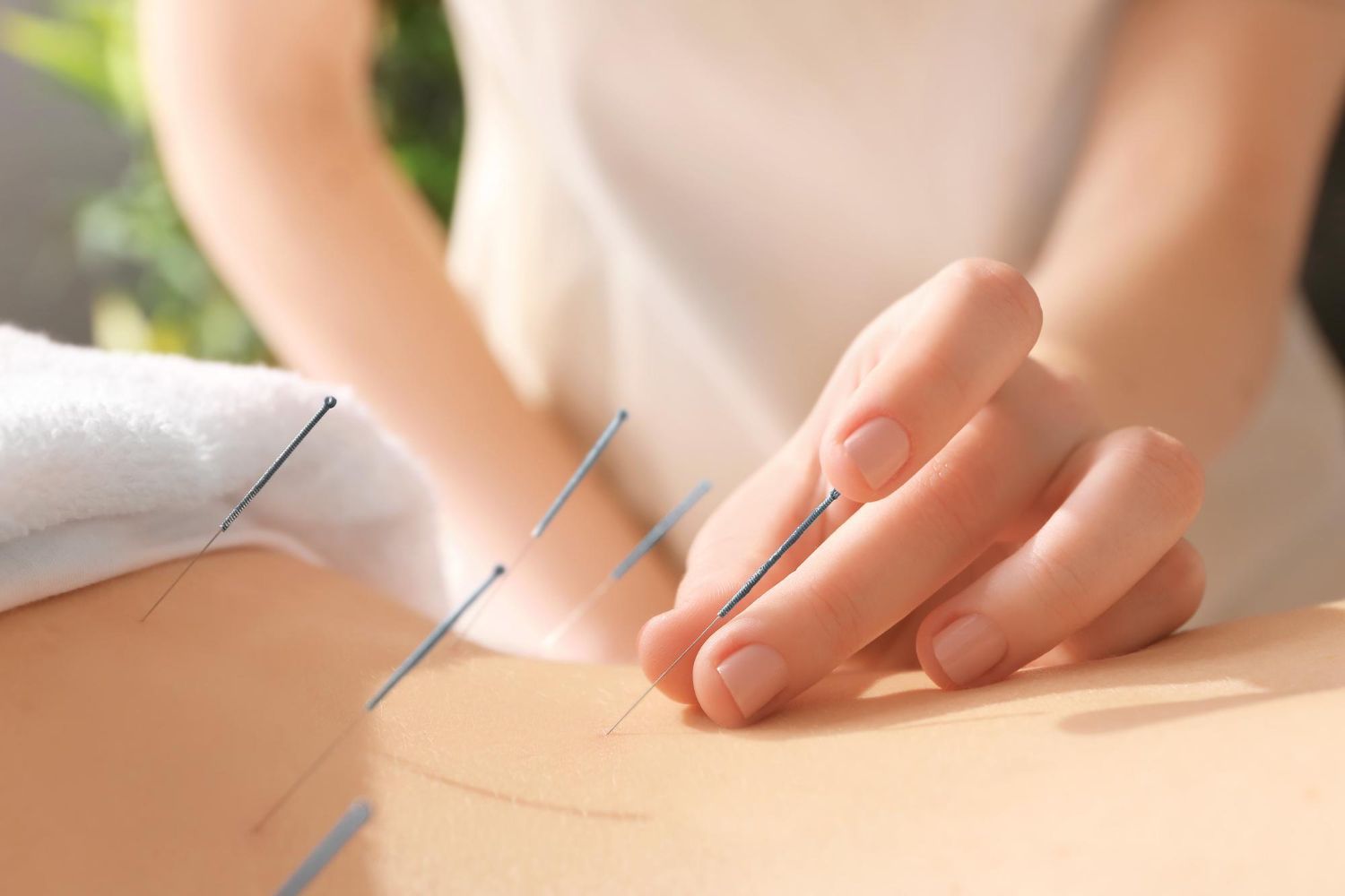 Physiotherapy essex - Acupuncture treatment