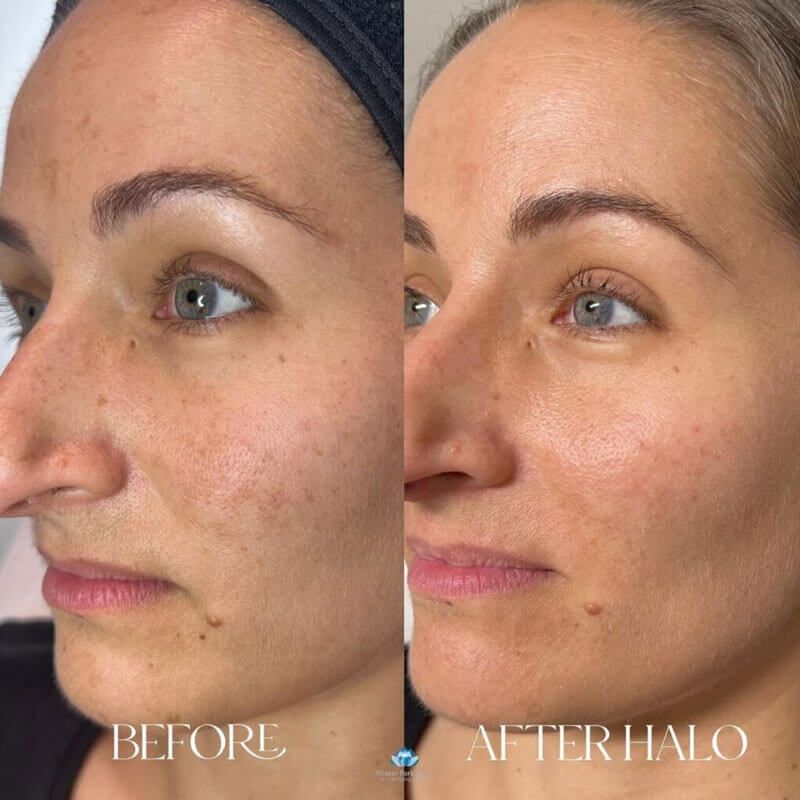 Comparison of a woman's face before and after a Halo laser treatment, showing improved skin tone and reduced spots.