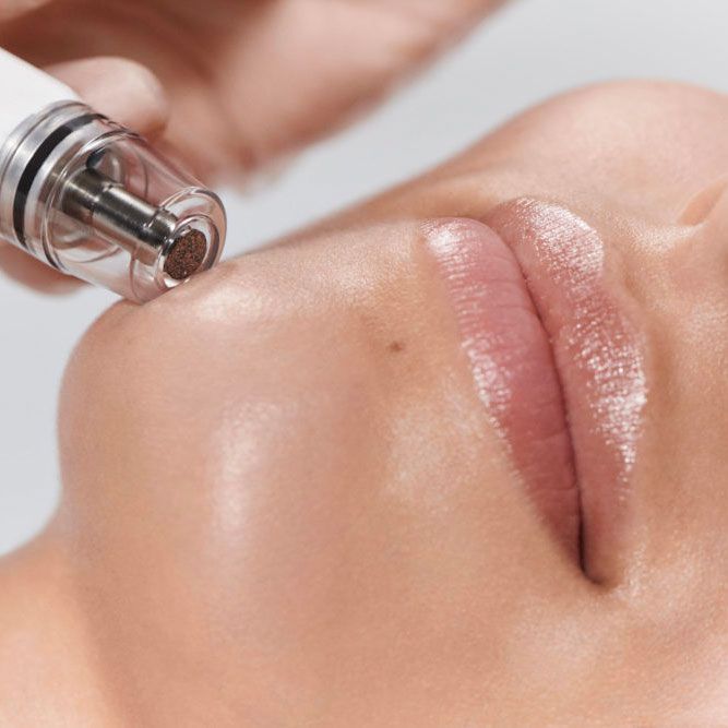 A person receiving a microdermabrasion treatment on their face.