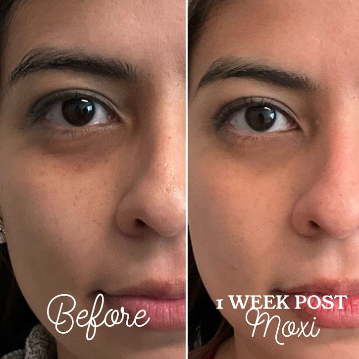 Side-by-side comparison of a person's face. Left side: before, showing dark circles. Right side: one week post Moxi, showing lighter skin.