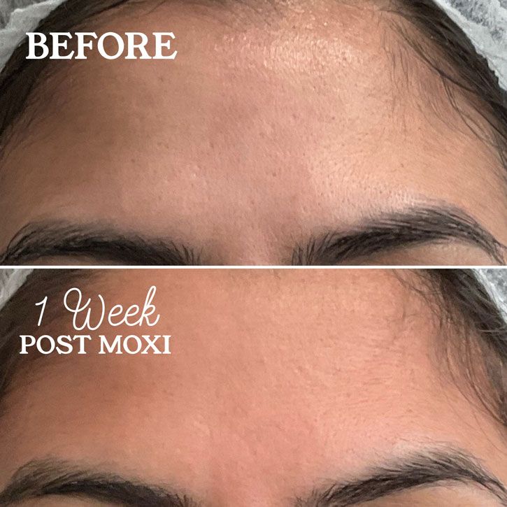 Comparison of a forehead