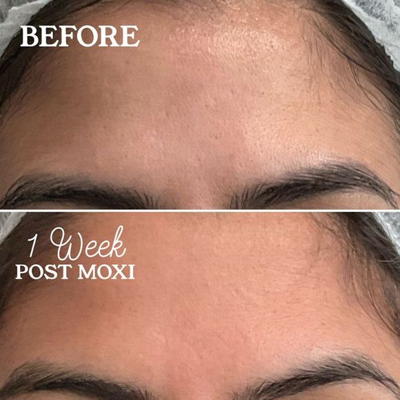 Comparison of a forehead 
