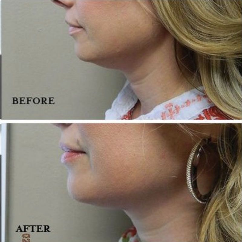 Before-and-after of a woman's chin and neck. The "after" shows reduced fat under the chin.