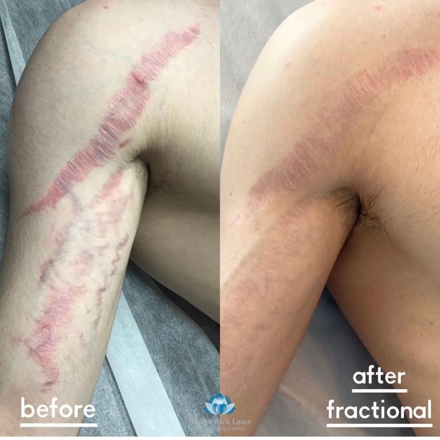 Arm with scar before and after fractional laser treatment; scar appears diminished in the "after" photo.