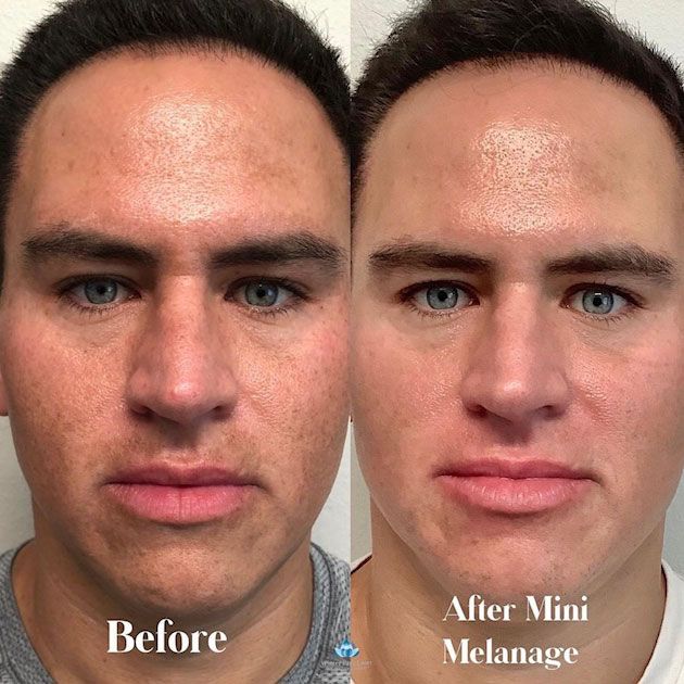Side-by-side facial comparison showing before and after Mini Melanage treatment; skin discoloration reduced.
