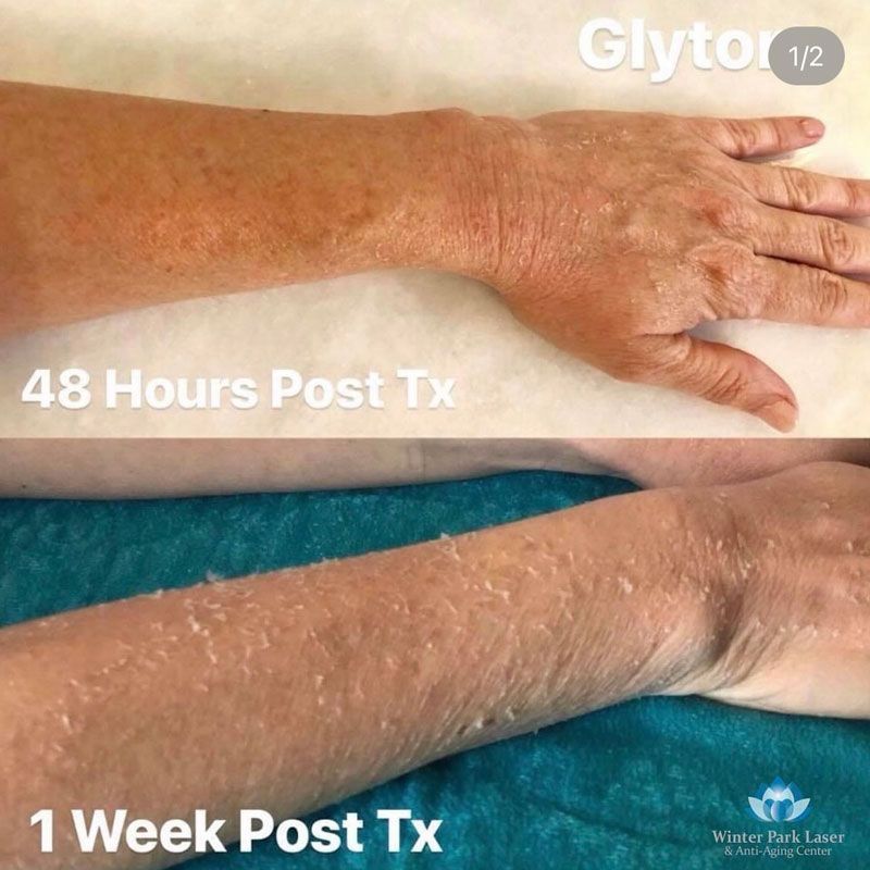 Two photos showing arm and hand before and after a treatment, with peeling skin visible in the after photo.