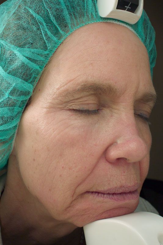 Woman with closed eyes wearing a surgical cap, resting chin on a device, with wrinkles visible.