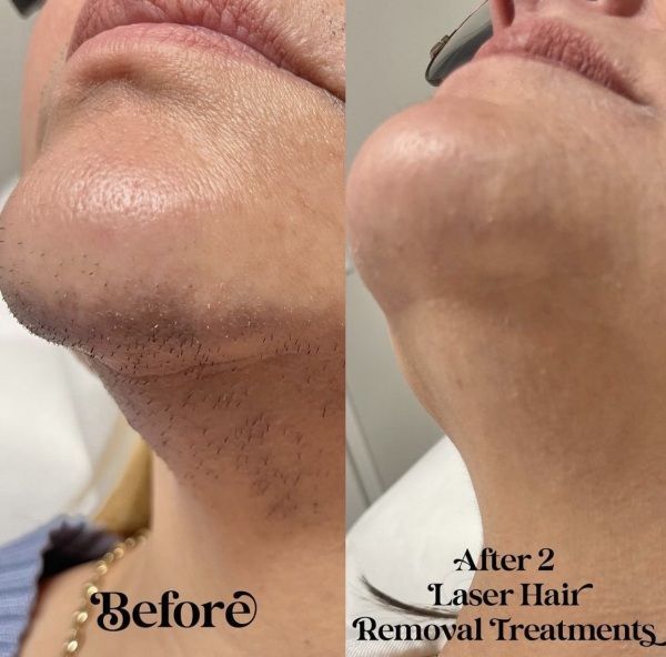Before and after comparison of laser hair removal on a chin; noticeably reduced hair after two treatments.