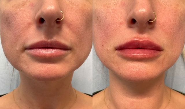 Before and after photos of a person's face. The right photo shows plumper lips and smoother skin.