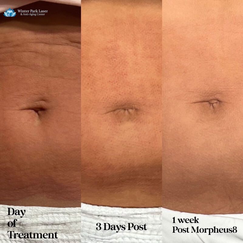 Abdomen before and after Morpheus8 treatment. Day of treatment shows wrinkles. 3 days post, skin is red. 1 week post shows smoother skin.