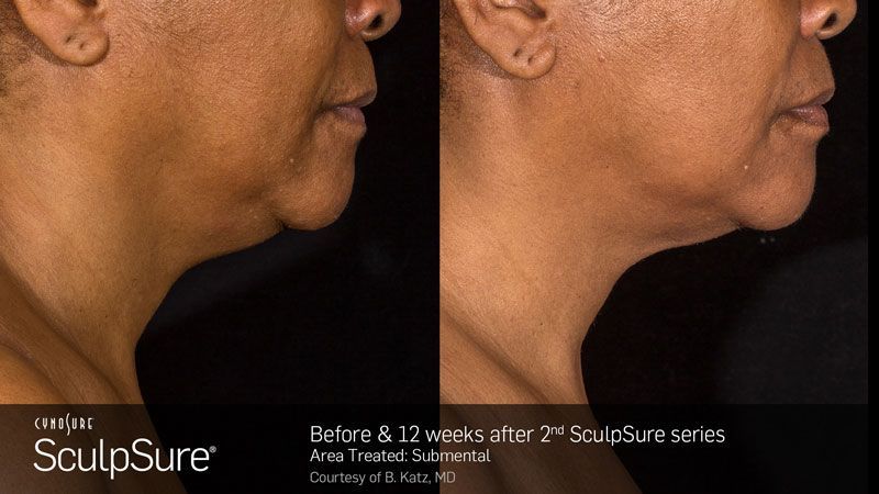 Side-by-side comparison: neck before and 12 weeks after SculpSure treatments, showing reduced fullness.