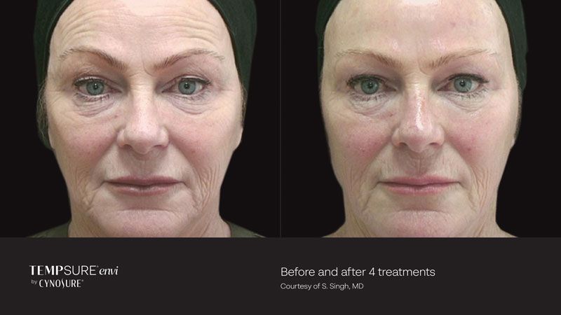 Side-by-side view of a face before and after treatments, reducing wrinkles and enhancing skin.