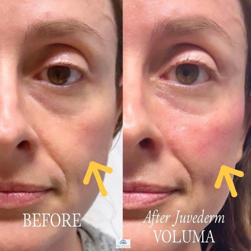 Before and after photos of a woman's face, showing a reduction in wrinkles and increased volume after Juvederm Voluma treatment.