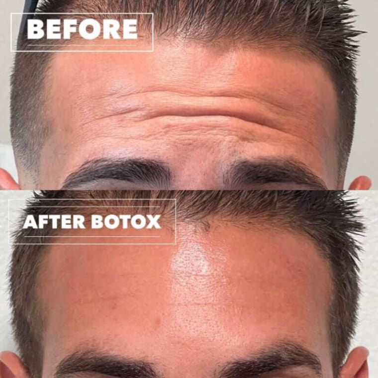 Forehead with wrinkles before Botox treatment, smoother after.