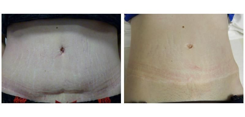 Two views of an abdomen; one with stretch marks and one with a cesarean scar.