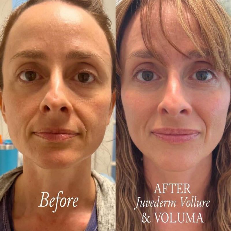 Before and after Juvederm Voluma and Vollure treatment: woman's face, diminished nasolabial folds, fuller lips.