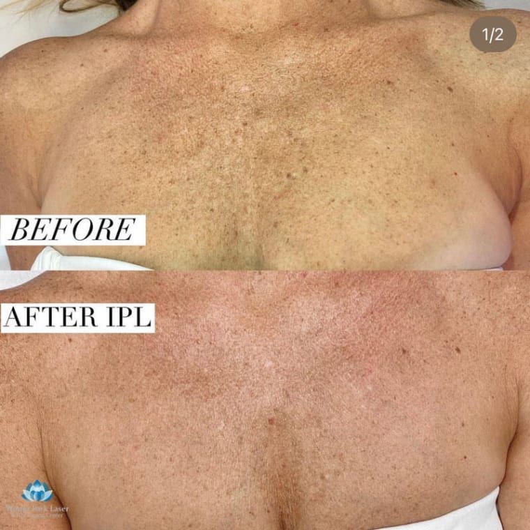 Side-by-side comparison of a chest showing sun damage "before" and "after" IPL treatment, with fewer brown spots.