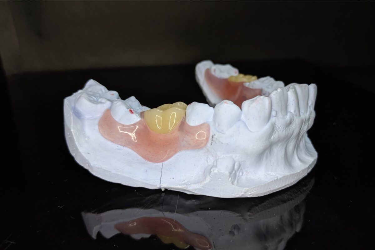 Model of a Person 's Teeth With a Denture on a Black Surface — Cosmetic Denture Services–Jacob Maxwell in Proserpine, QLD