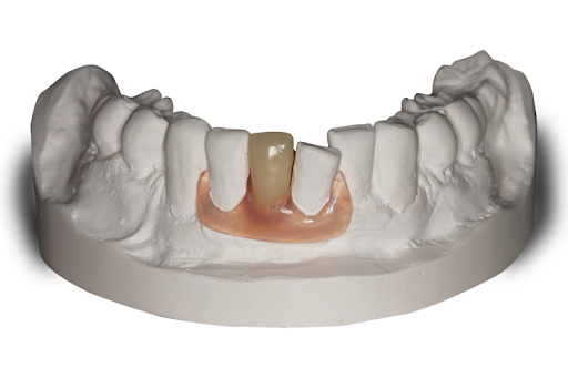 Model of a Person 's Teeth With a Tooth Missing — Cosmetic Denture Services–Jacob Maxwell in Proserpine, QLD