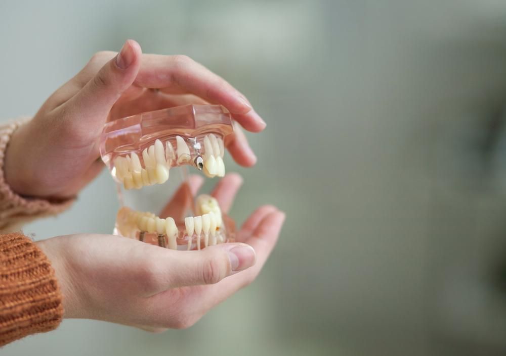 A Person Is Holding a Model of A Person 's Teeth in Their Hands — Cosmetic Denture Services–Jacob Maxwell in Moranbah, QLD