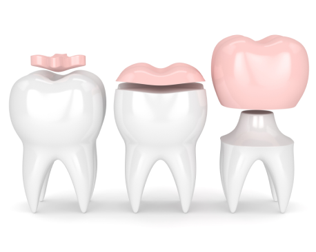 Three teeth with different types of dental fillings on them.
