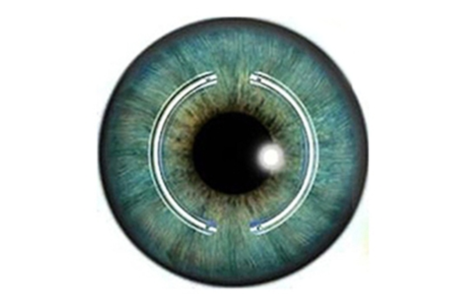 Íris humana azul-esverdeada com dois segmentos de anel corneano implantados circundando a pupila.