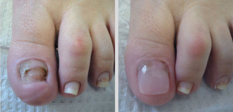 Keryflex before and after photo 12
