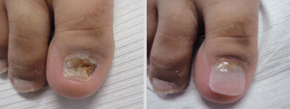 Keryflex before and after photo 11
