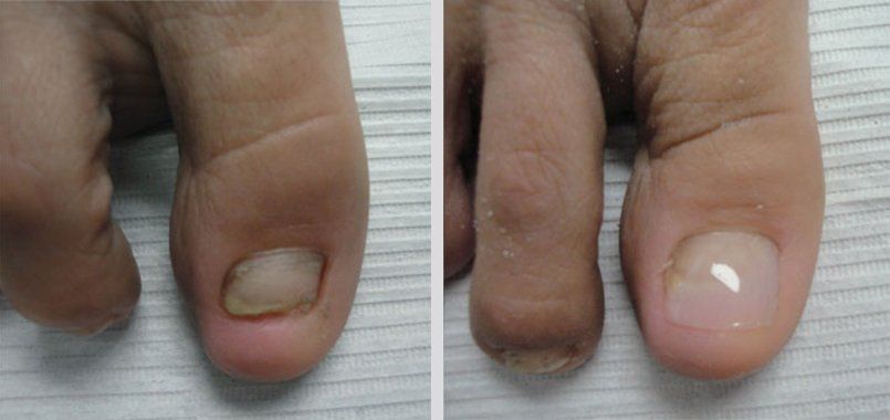 Keryflex before and after photo 9