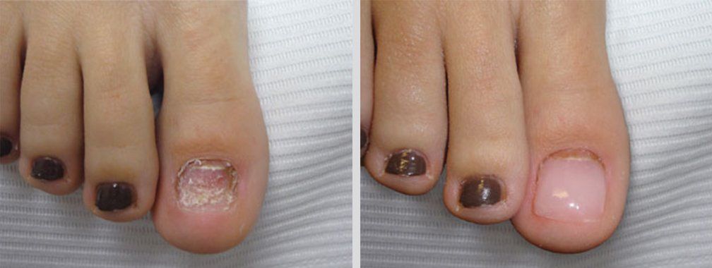Keryflex before and after photo 8