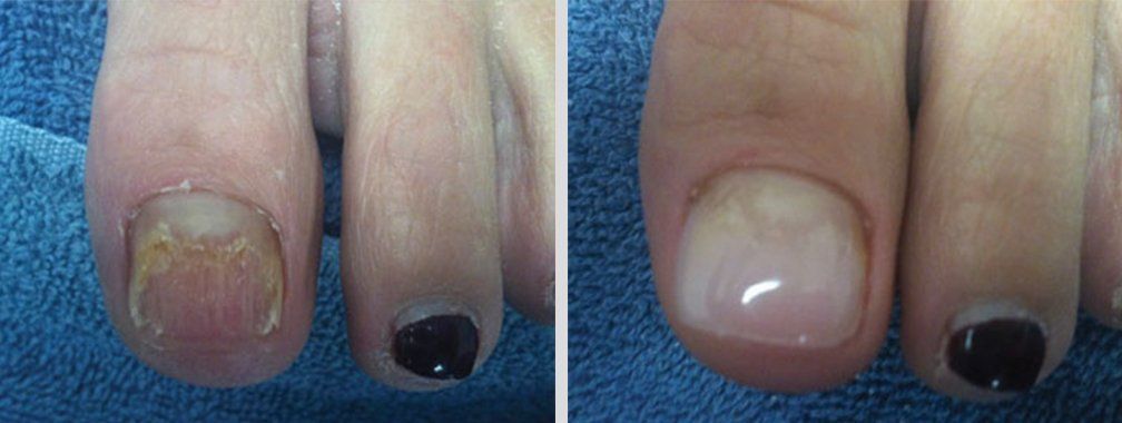 Keryflex before and after photo 10