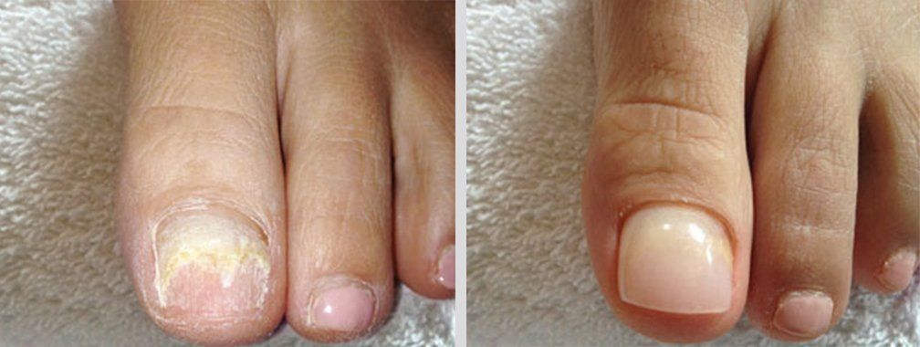 Keryflex before and after photo 13