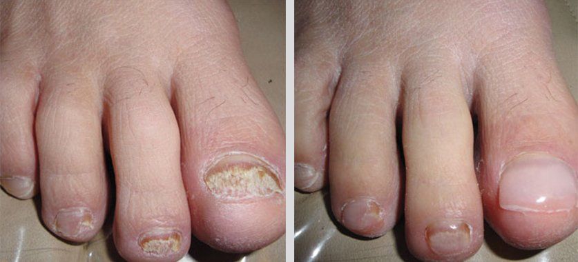 Keryflex before and after photo 17