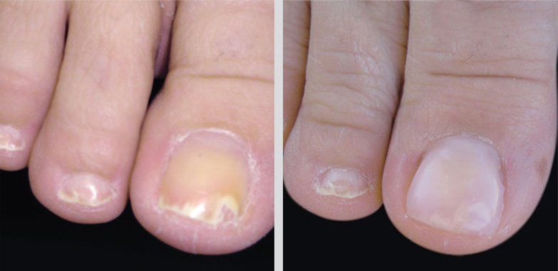 Keryflex before and after photo 16