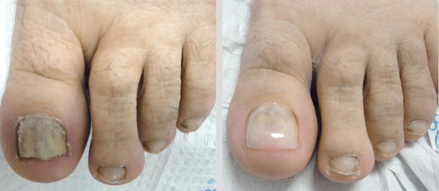 Keryflex before and after photo 2