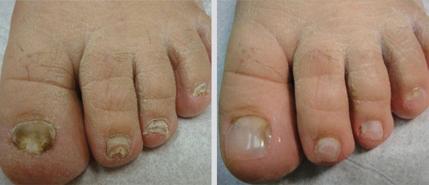 Keryflex before and after photo 4