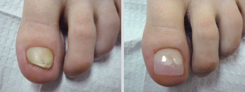 Keryflex before and after photo 6