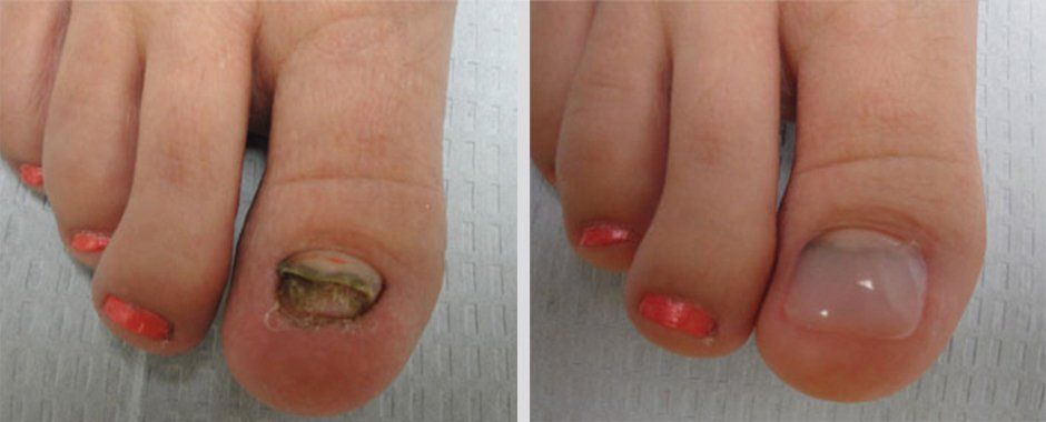 Keryflex before and after photo 7