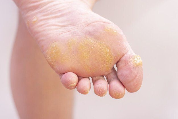 Wart Treatment