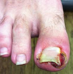 infected ingrown toenail
