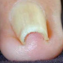 infected ingrown toenail